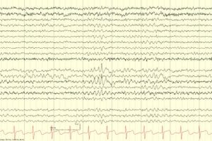 Wickets Wickets on EEG tracing