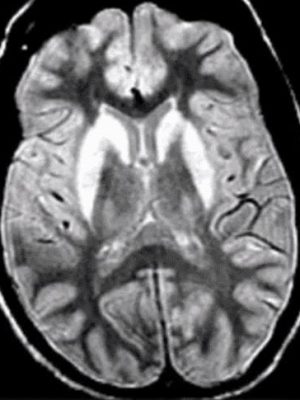 Wilsons Disease Wilsons disease axial MRI with T2 hyperintensity in the bilateral putamen and caudate