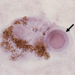 Lewy Body Alpha-synuclein stain on high power showing a Lewy Body