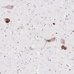 Lewy Body Lewy Body on Alpha-synuclein stain