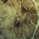 Chloroquine Myopathy Chloroquine Myopathy on Acid phosphatase-positive stain