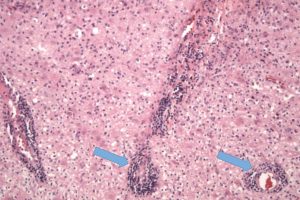 Active MS Plaque Active MS Plaque on brain biopsy showing an active demyelinating plaque with perivascular lymphocytes, macrophages, and reactive astrocytes