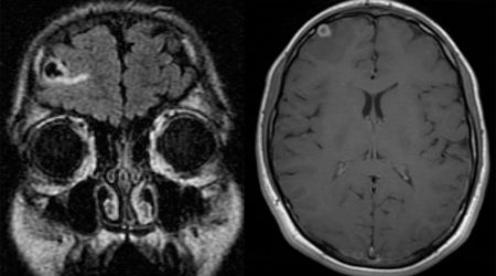 Acute Cysticercosis Neuroinfectious disease Acute Cysticercosis on MRI brain