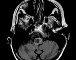 Acute Hemorrhage in Pontine Cavernous Malformation Acute Hemorrhage in Pontine Cavernous Malformation on T2 FLAIR MRI