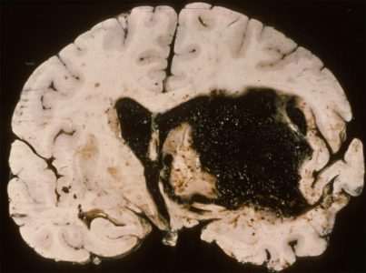 Acute Intraparenchymal Hemorrhage Acute Intraparenchymal Hemorrhage on coronal gross pathology section