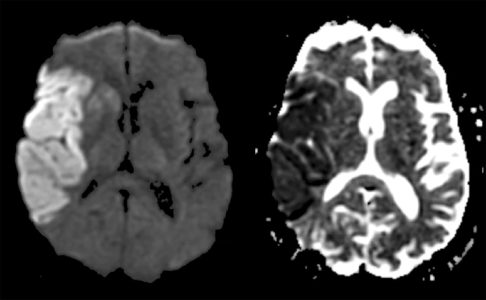 Acute Right MCA Infarct Acute Right MCA Infarct on brain DWI and ADC