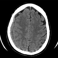 Acute Right Subdural Hematoma Acute Right Subdural Hematoma on axial CT head