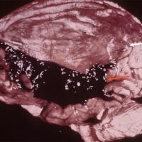 Acute Subdural Hematoma Acute Subdural Hematoma on Sagittal gross view