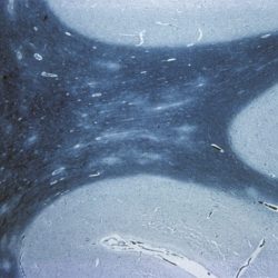 Acute Disseminated Encephalomyelitis Acute Disseminated Encephalomyelitis on brain biopsy Luxol fast blue stain, low power view, showing several pale demyelinated areas in the cortical white matter
