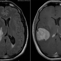 AIDS Lymphoma AIDS Lymphoma on axial view brain MRI T2 FLAIR and T1 with contrast