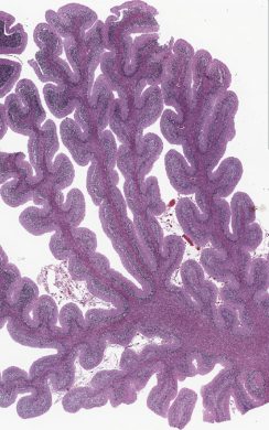 Cerebellar Atrophy Cerebellar atrophy on pathologic specimen