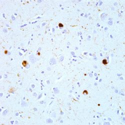 Lewy Bodies Immunostaining of alpha synuclein in Lewy Bodies and Lewy Neurites in the neocortex of a patient with Lewy Body Disease