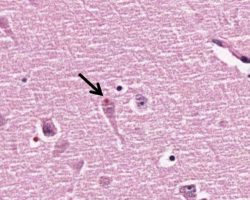 Alzheimer's Disease Alzheimer's Disease patient pathology specimen with a hirano body