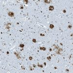 Alzheimer's Disease Alzheimer's Disease Amyloid stain with beta-amyloid plaque