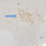 Cortical Heterotopia Epilepsy patient with Cortical Heterotopia on Anti-NeuN stained biopsy