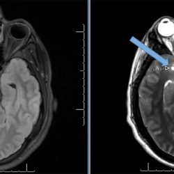 Arachnoid Cyst Arachnoid Cyst on axial brain MRI