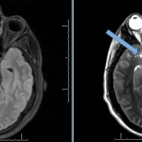 Arachnoid Cyst Arachnoid Cyst on axial brain MRI