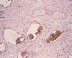 Arteriovenous Malformation Arteriovenous Malformation biopsy microscopic slide specimen