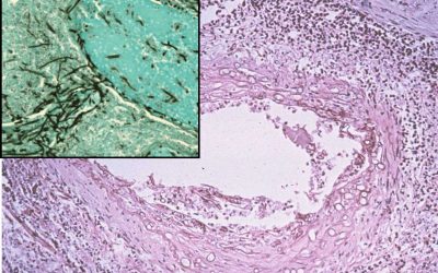 Aspergillosis Aspergillosis neuropathology slide with silver staining