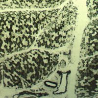 Dermatomyositis ATPase stain with perifascicular atrophy in Dermatomyositis