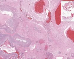 Arteriovenous Malformation Arteriovenous Malformation Low power view H&E stain with closely juxtaposed, large-caliber blood vessels with arterialized veins