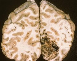 Arteriovenous Malformation Arteriovenous Malformation on brain gross specimen