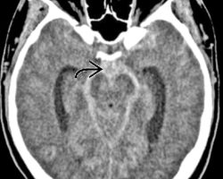 Basilar Aneurysm Rupture Basilar Aneurysm Rupture on CT