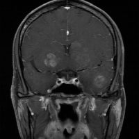 B Cell Lymphoma B Cell Lymphoma on Coronal MRI, T1 sequence w/ contrast