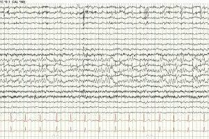 Breach Rhythm of the Left Temporal Lobe EEG tracing showing Breach Rhythm of the Left Temporal Lobe