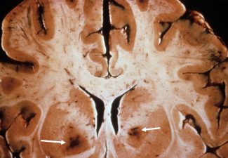 Carbon Monoxide Poisoning Carbon Monoxide Poisoning causing Bilateral globus pallidus hemorrhage on pathologic specimen