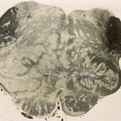 Caudal Medulla in ADEM ADEM Axial section of the lower medulla shows several overlapping lucent lesions, giving it a moth-eaten appearance