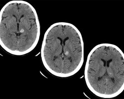 Cavernous Malformation located in the left thamaus Cavernous Malformation on CT scan axial cut