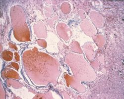 Cavernous Malformation Cavernous Malformation on neuropathology slide Trichrome stain showing packed vascular sinuses