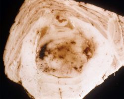 Medulloblastoma Cerebellar Medulloblastoma gross pathology specimen