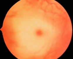 Funduscopic image showing a red macula surrounded by lighter colored tissue, consistent with a cherry red spot. By Jonathan Trobe, M.D., CC BY 3.0, via Wikimedia Commons https://commons.wikimedia.org/wiki/File:Tay-sachsUMich.jpg Neurology Pathology Exam Review cherry red spot