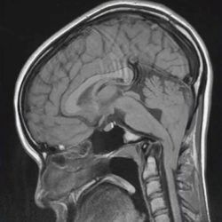 Chiari 1 Malformation Chiari 1 Malformation on sagittal spine MRI
