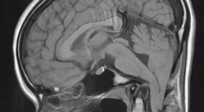 Chiari 1 Malformation Chiari 1 Malformation on sagittal spine MRI