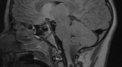 Chiari 1 Malformation with Holocord Syrinx Chiari 1 Malformation with Holocord Syrinx on MRI