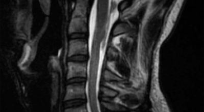 Chiari 1 Malformation Chiari 1 Malformation on sagittal spine mri