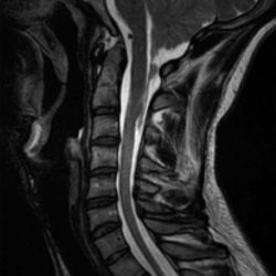 Chiari 1 Malformation Chiari 1 Malformation on sagittal spine mri