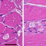 Chloroquine Myopathy Chloroquine Myopathy biopsy with granular amphophilic granules