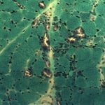 Chloroquine Myopathy Chloroquine Myopathy biopsy with rounded fibers and vacuolar sarcoplasm