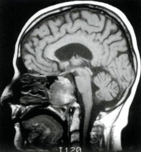T1-weighted MRI, sagittal cut showing a destructive lesion arising from the clivus Chordoma