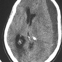 Chronic Left Subdural Hematoma Chronic Left Subdural Hematoma on axial CT.