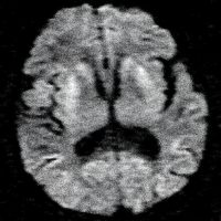 Creutzfeldt-Jakob disease (CJD) on DWI MRI Restricted Diffusion of Cortical Mantle and Basal Ganglia in CJD