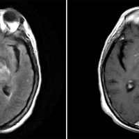 CNS Lymphoma CNS Lymphoma on axial brain MRI T2 FLAIR and T1 with contrast