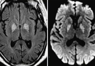Carbon Monoxide Poisoning Carbon Monoxide Poisoning on DWI with bilateral globus pallidus hyperintensities