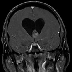 Colloid Cyst in the Foramen of Monro Colloid Cyst in Foramen of Monro on Coronal MRI, T2 FLAIR sequence