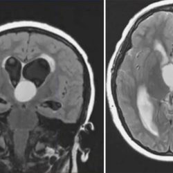 Colloid Cyst Colloid Cyst on coronal and axial T2 FLAIR MRI