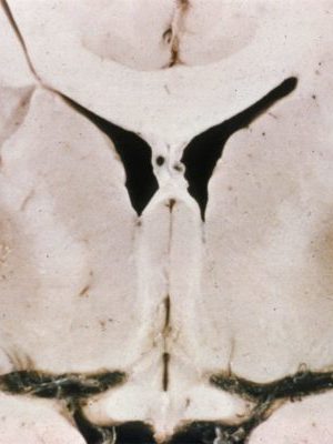 Wilson's Disease Wilson's Disease pathologic specimen with Copper accumulation in bilateral putamen